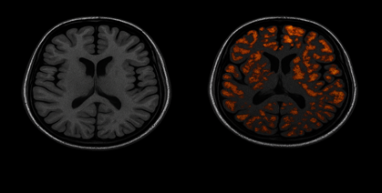 Two brain MRI scans: left shows normal anatomy, right highlights orange regions indicating areas of interest.